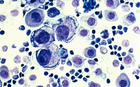 Lenfoma: Lenf Kanseri Nedir ve Türleri Nelerdir?